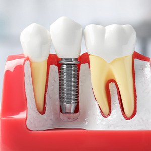 Close-up of model of dental implant between teeth