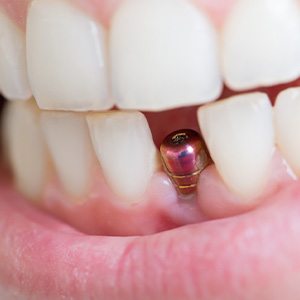 Close-up of unrestored dental implant in lower arch