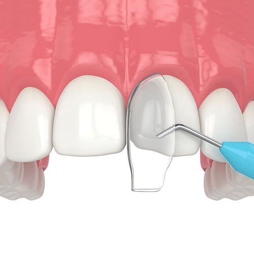 Illustration of cosmetic bonding being performed on upper teeth