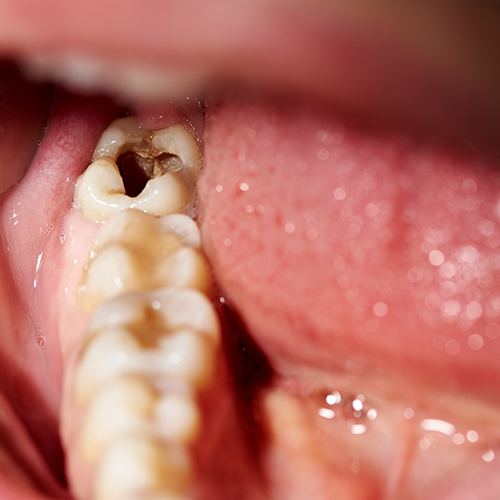 Close-up of badly damaged teeth in lower arch