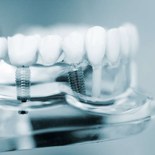 Close-up of dental implants in Los Gatos in plastic tray