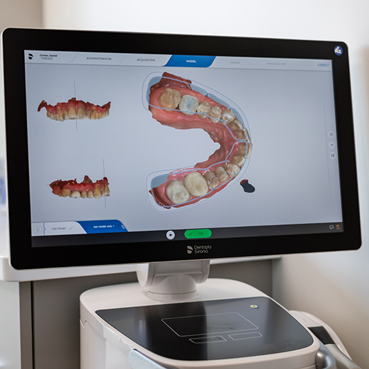 Digital impressions of teeth on computer monitor