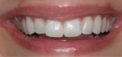 Close-up of smile after dental treatment