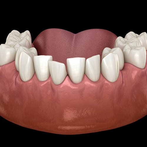 Illustration of multiple misaligned teeth