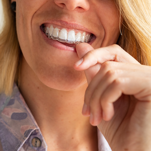 Woman wearing Invisalign clear aligners