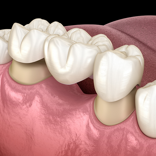 Illustration of dental bridge being attached to prepared teeth