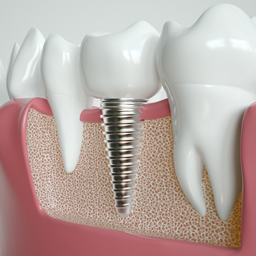 Illustration of a dental implant between two natural teeth