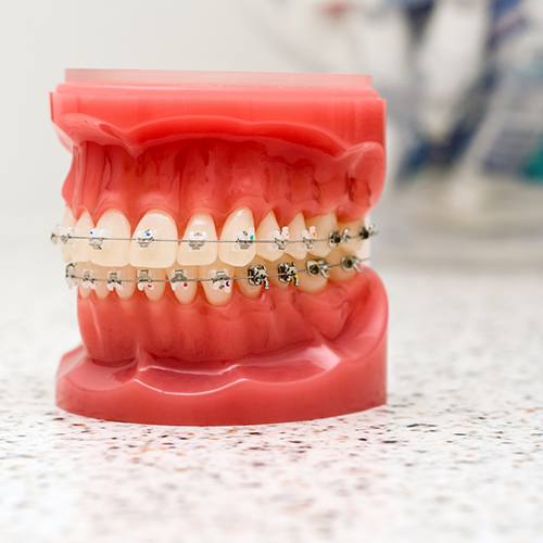 Traditional braces on model of teeth as concept for orthodontics in Los Gatos