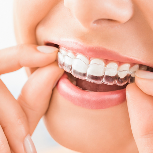 Close-up of woman placing Invisalign on upper teeth