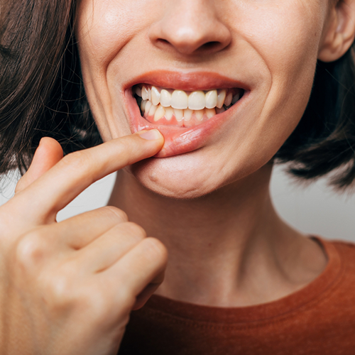 Woman pulling down lip to show gums