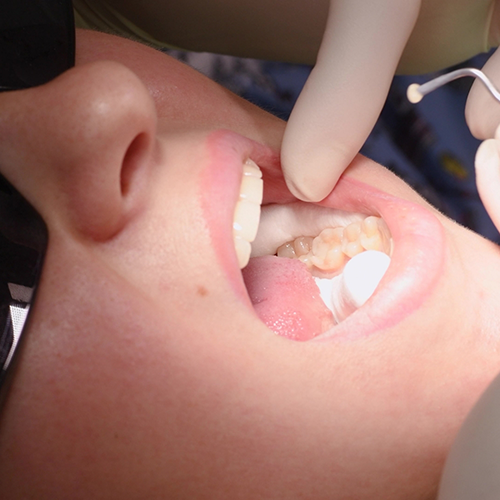 Opening mouth to show teeth with tooth-colored fillings