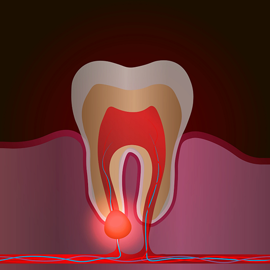 Illustration of tooth with infection