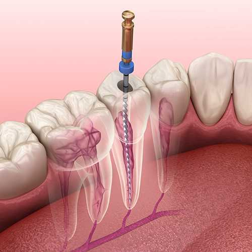 Illustration of root canal treatment in Los Gatos