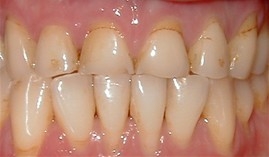 Smile with worn down upper teeth