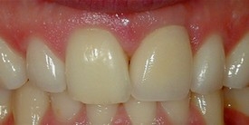 Close-up of smile after front tooth has been replaced