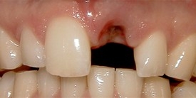 Close-up of smile with a missing upper front tooth