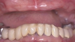 All teeth missing in upper arch