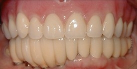 Smile with severe gum recession in lower arch