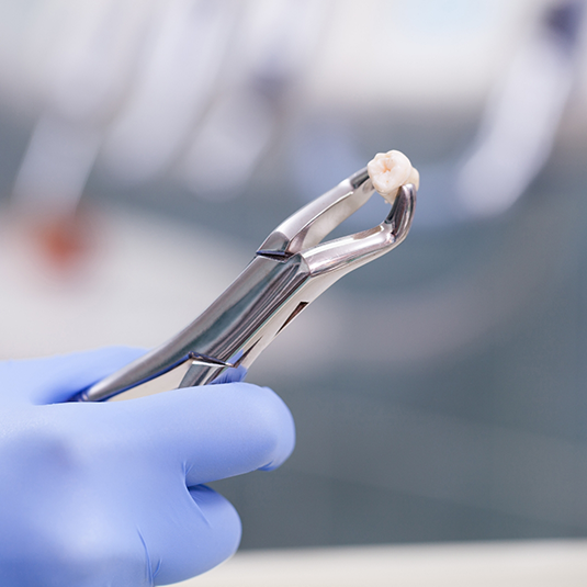 Gloved hand with forceps holding tooth after tooth extraction in Los Gatos