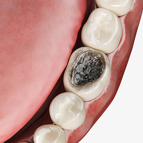 Illustration of a badly decayed tooth in mouth